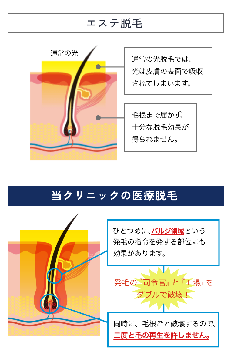 エステ脱毛と医療脱毛の比較図